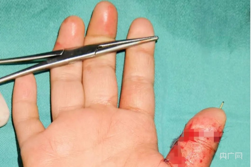 妙手接断指 手足显微外科再放异彩助男童拇指复原