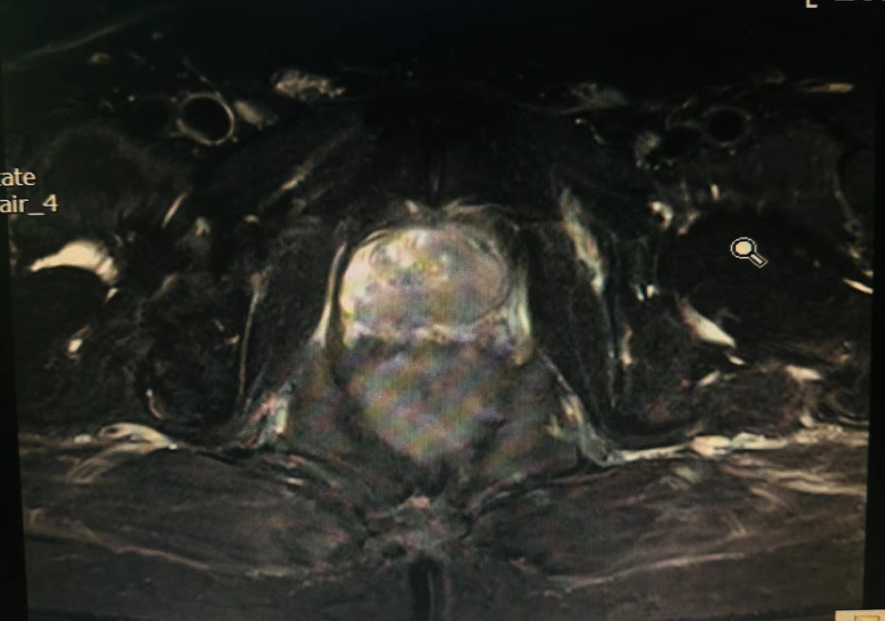 前列腺癌b超图片