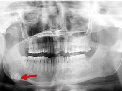男子一吃饭就疼得张不开嘴！医生：千万不要忍