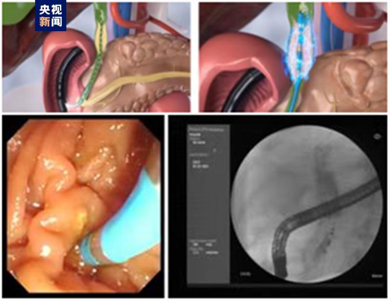 内窥镜电极怎么回事世界首例内镜下脉冲电场肿瘤消融术在西安成功实施_https://www.jmylbn.com_新闻资讯_第1张