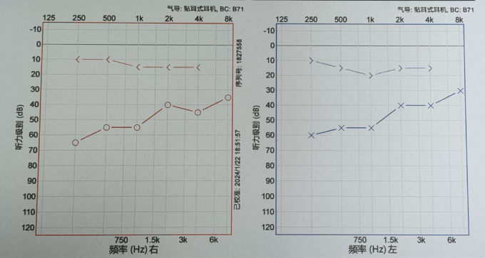 听力检查报告正常图片图片